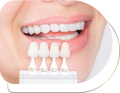 لمینت دندان